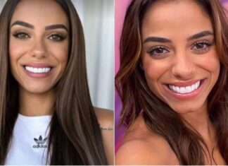 Key Alves aparece com harmonização facial e surpreende; entenda tudo os procedimentos aplicados nela