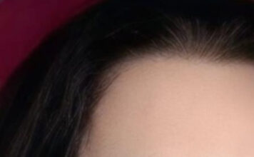 Remoção e transplante de sobrancelhas crescem com busca por naturalidade