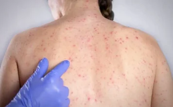 Casos de sarampo sobem para 16 em São Paulo
